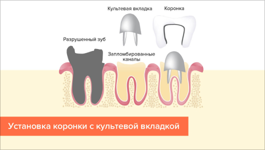 Культевая вкладка Томск Баргузинская Лечение периостита Томск Васильковый